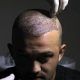Best Hair Transplantation clinic in Raipur 2 HTP IMAGE