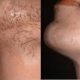 HAIR REMOVAL DIGITAL