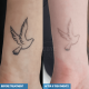 Tatto Removal clinic in Raipur 3 Tattoo removal digital photo