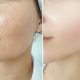skin treatment digital