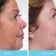Melasma digital