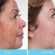Melasma digital