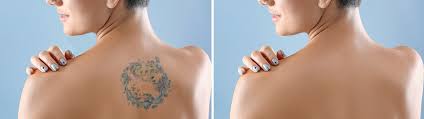 tatto removal digital
