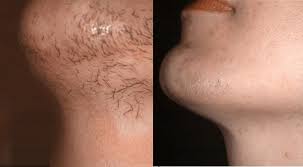 HAIR REMOVAL DIGITAL 1