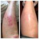 Psoriasis digital