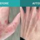 eczema digital