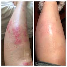 Psoriasis digital