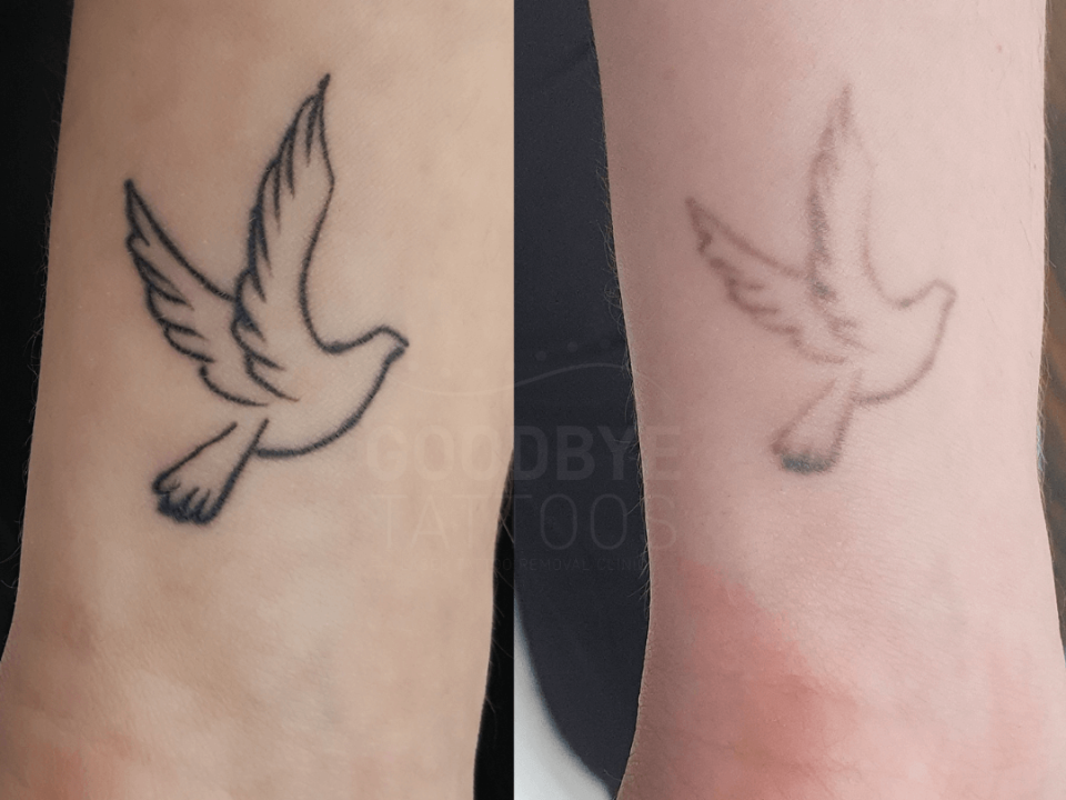 Tattoo removal digital photo
