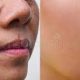 melasma beforeafter