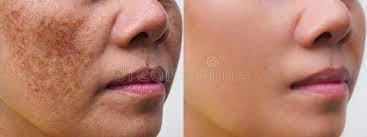 melasma beforeafter