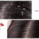 Dandruff digital