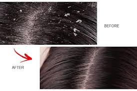 Dandruff digital