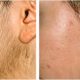 HAIR REDUCTION 1