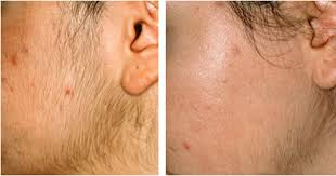 HAIR REDUCTION