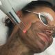 best carbon laser treatment clinic in Raipur. 2 carbon peel blog
