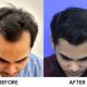 best hair transplant treatment clinic in Raipur. 3 images 1