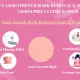 laser stretch mark removal