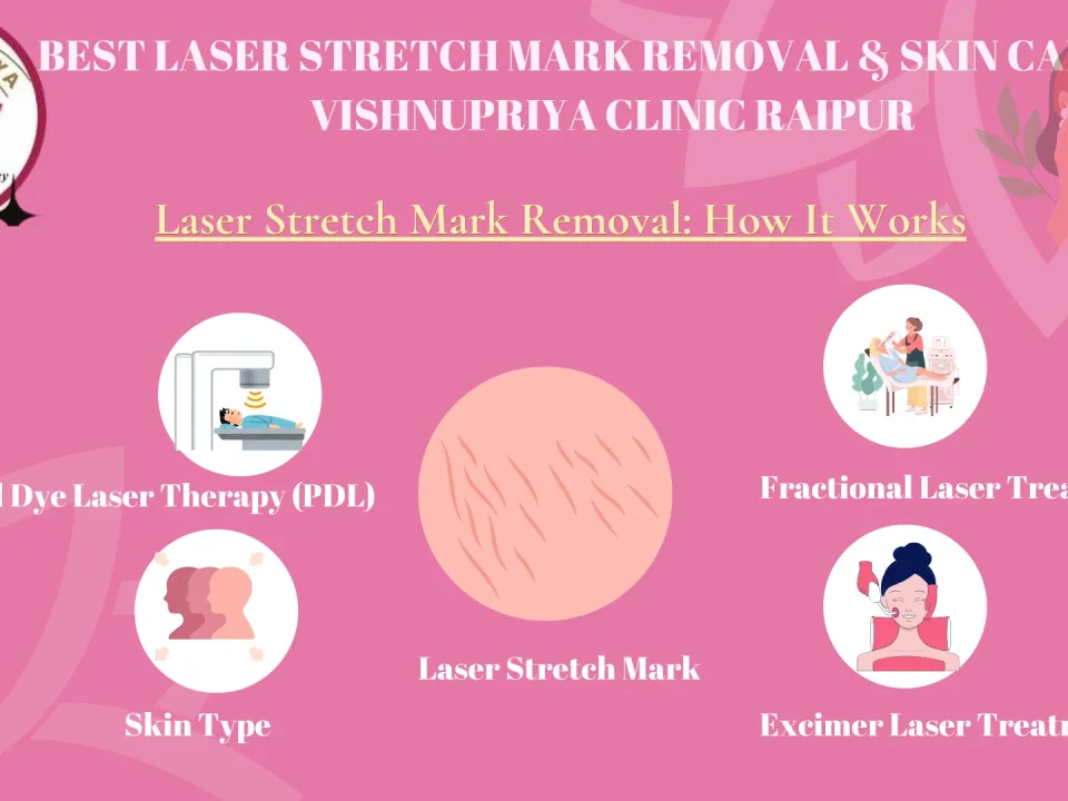 laser stretch mark removal